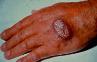 Lesión por leishmania en humanos